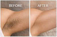 Opaline - IPL Laser Hair Removal